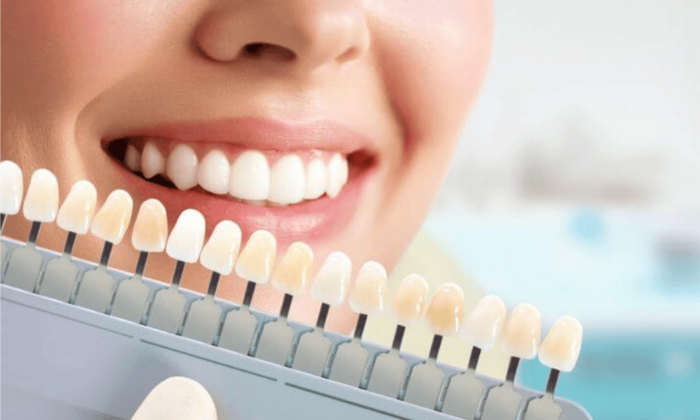 Veneers